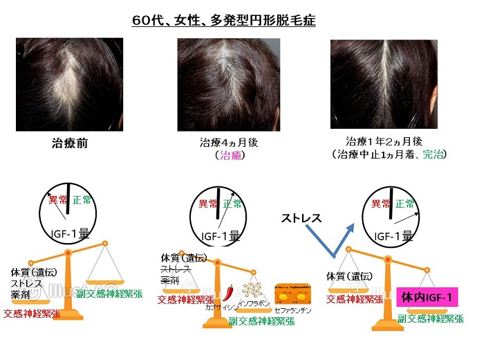 円形脱毛症　病院